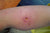 Flesh-eating bacteria could be spread by mosquitoes, scientists warn