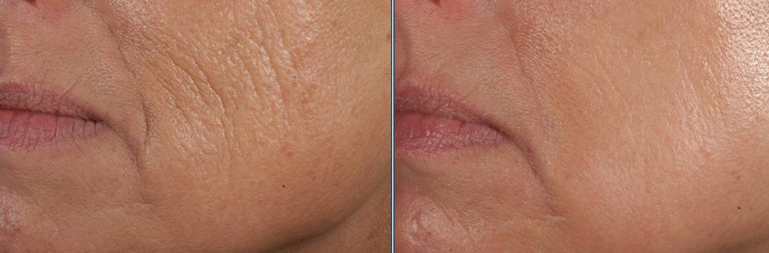 Peptides Role In Skin Rejuvenation