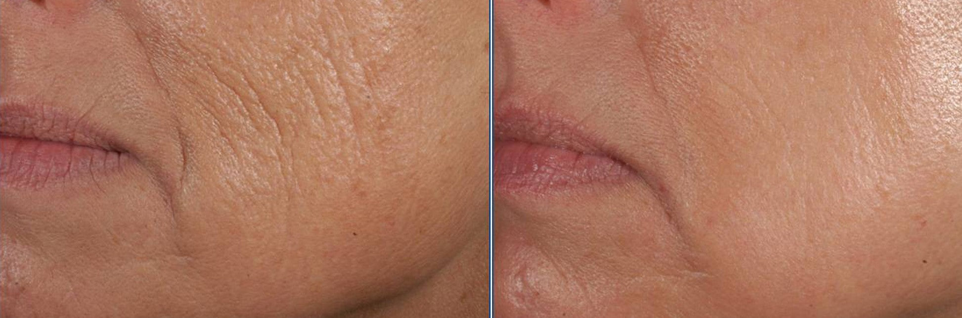 Peptides Role In Skin Rejuvenation